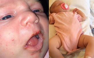 La neonata con l'herpes (Foto facebook)