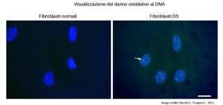 Visualizzazione delle lesioni di tipo ossidativo nel DNA di cellule del derma (fibroblasti) da paziente Down, rispetto a cellule di individuo sano. L’immagine ottenuta mediante microscopia in fluorescenza mostra i nuclei cellulari contenenti il DNA (in blu) e la presenza delle lesioni ossidative (indicate dalla freccia) evidenziate mediante reazione immunofluorescente (in verde). La barra bianca corrisponde ad un centesimo di mm.