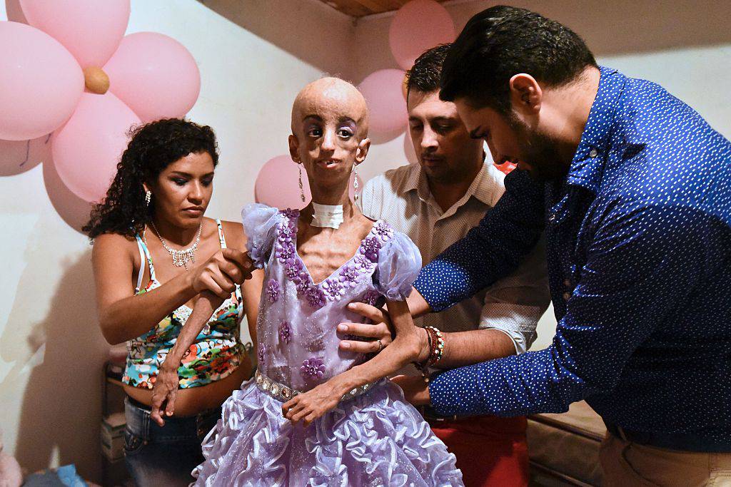 Magali Gonzalez Sierra (C), 15, is dressed by her mother Sofia Sierra (L) and Colombia's fashion designer Miguel Becerra (R), for her 15th birthday party in El Cabuyal, department of Valle del Cauca, Colombia, on January 16, 2016. Magali suffers from Hutchinson-Gilford progeria syndrome, a disease that causes premature aging in children, whose average lifespan is 13 years old. Magali's dream of celebrating her 15th birthday with a big party is today fulfilled with the help of neighbors and friends. AFP PHOTO / LUIS ROBAYO / AFP / LUIS ROBAYO (Photo credit should read LUIS ROBAYO/AFP/Getty Images)