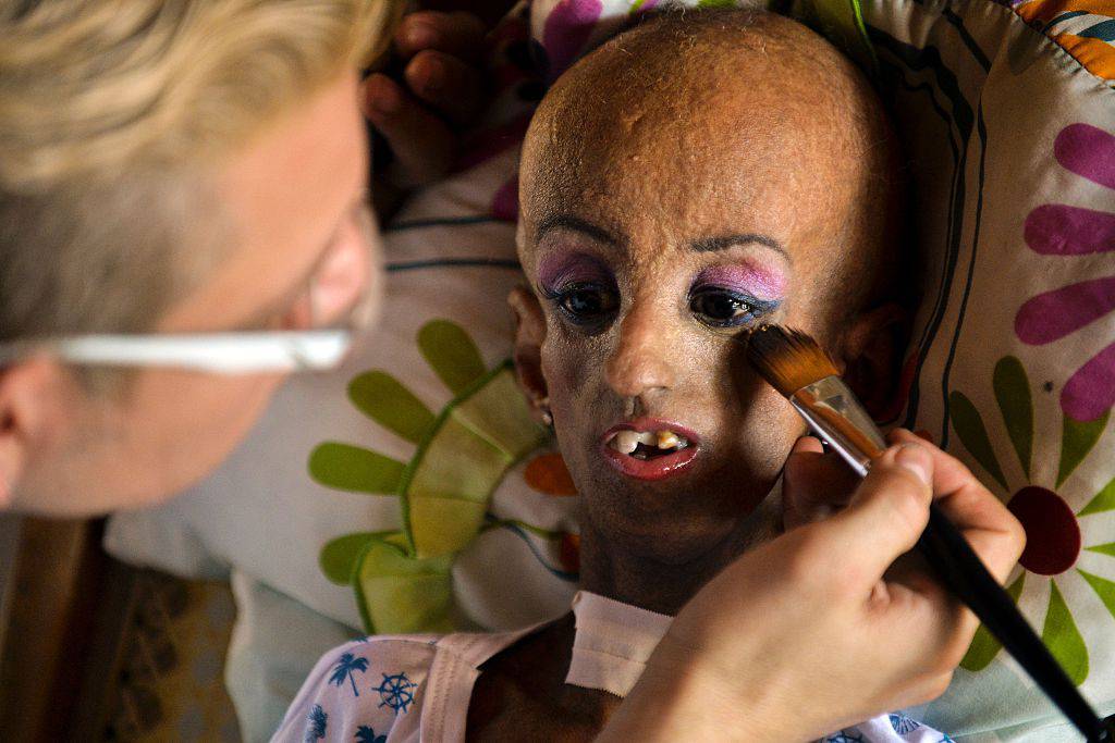 Colombian Magali Gonzalez Sierra, 15, gets her make-up done for her 15th birthday party in El Cabuyal, department of Valle del Cauca, Colombia, on January 16, 2016. Magali suffers from Hutchinson-Gilford progeria syndrome, a disease that causes premature aging in children, whose average lifespan is 13 years old. Magali's dream of celebrating her 15th birthday with a big party is today fulfilled with the help of neighbors and friends. AFP PHOTO / LUIS ROBAYO / AFP / LUIS ROBAYO (Photo credit should read LUIS ROBAYO/AFP/Getty Images)