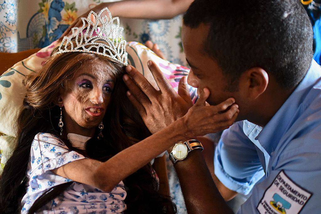 Colombian Magali Gonzalez Sierra (L), 15, speaks with her father Jose Eider Gonzalez before her 15th birthday party in El Cabuyal, department of Valle del Cauca, Colombia, on January 16, 2016. Magali suffers from Hutchinson-Gilford progeria syndrome, a disease that causes premature aging in children, whose average lifespan is 13 years old. Magali's dream of celebrating her 15th birthday with a big party is today fulfilled with the help of neighbors and friends. AFP PHOTO / LUIS ROBAYO / AFP / LUIS ROBAYO (Photo credit should read LUIS ROBAYO/AFP/Getty Images)
