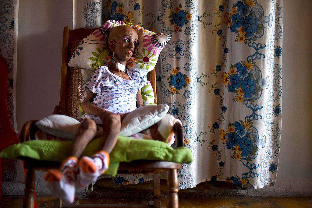 TOPSHOT - Colombian Magali Gonzalez Sierra, 15, prepares for her 15th birthday party in El Cabuyal, department of Valle del Cauca, Colombia, on January 16, 2016. Magali suffers from Hutchinson-Gilford progeria syndrome, a disease that causes premature aging in children, whose average lifespan is 13 years old. Magali's dream of celebrating her 15th birthday with a big party is today fulfilled with the help of neighbors and friends. AFP PHOTO / LUIS ROBAYO / AFP / LUIS ROBAYO (Photo credit should read LUIS ROBAYO/AFP/Getty Images)