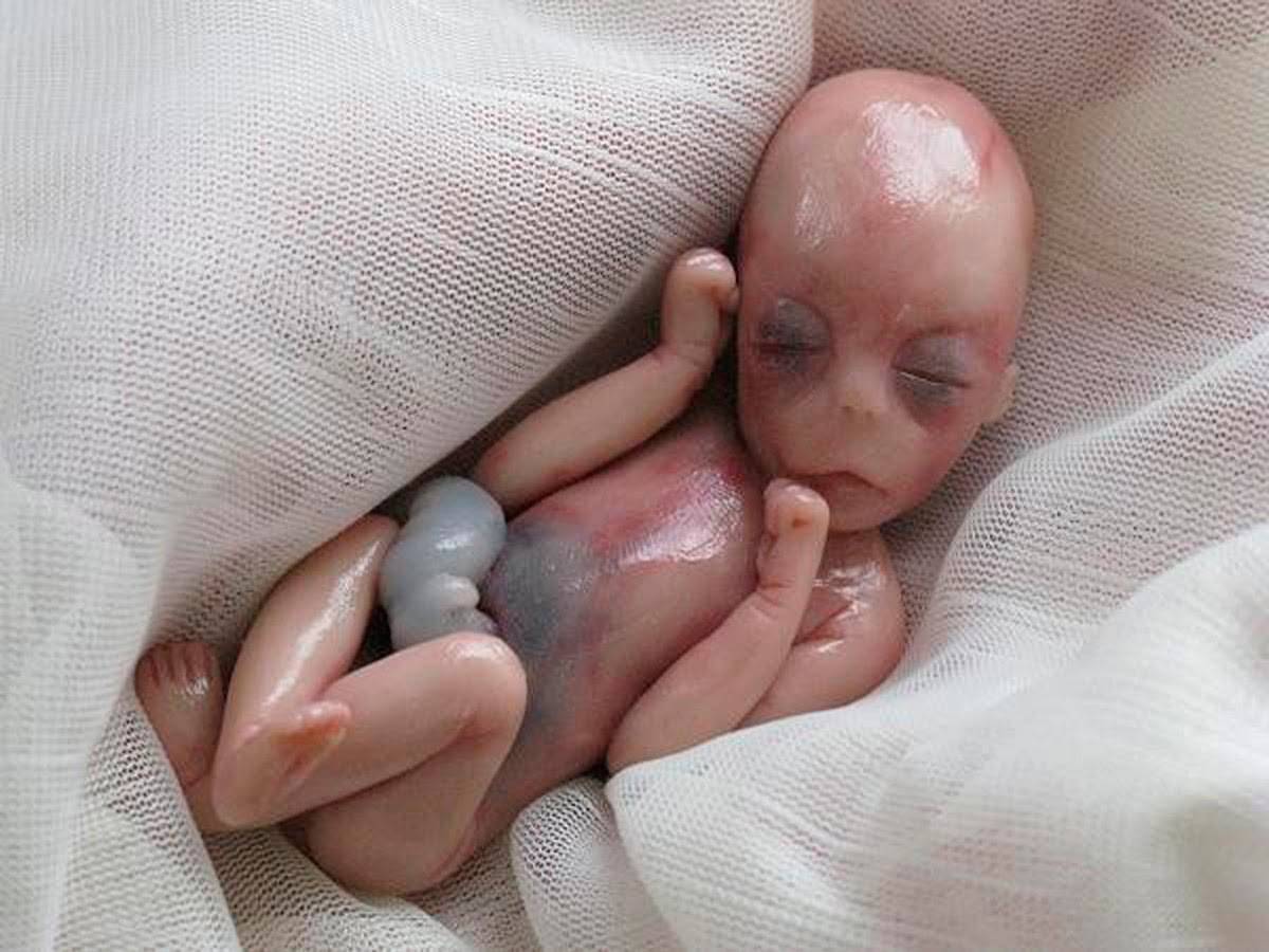 Bimba Nasce Di 5 Mesi Sembra Morta Poi Il Miracolo Eccola Oggi