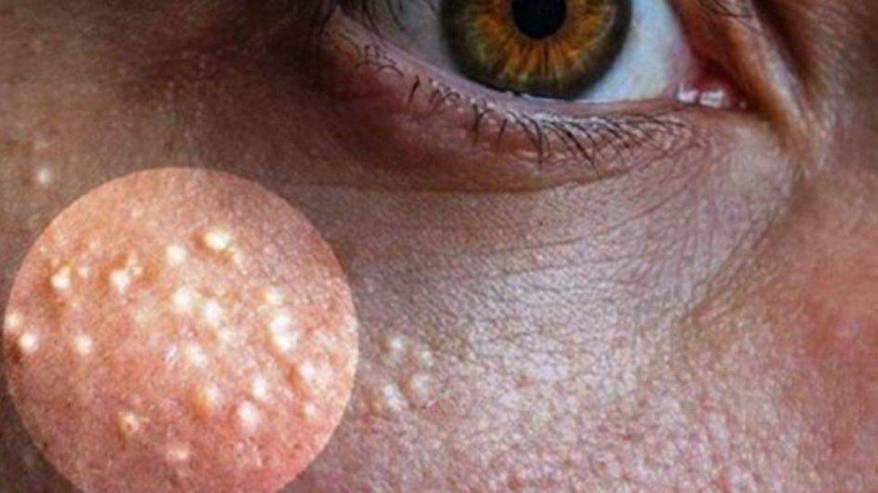 Grani di miglio o acne miliare: come combatterla con rimedi naturali