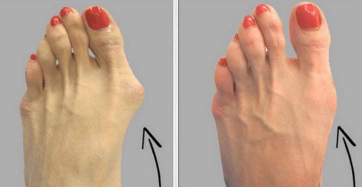 Pollice Valgo Un Vecchio Rimedio Naturale Efficace Pollice Valgo Un Vecchio Rimedio Naturale Efficace