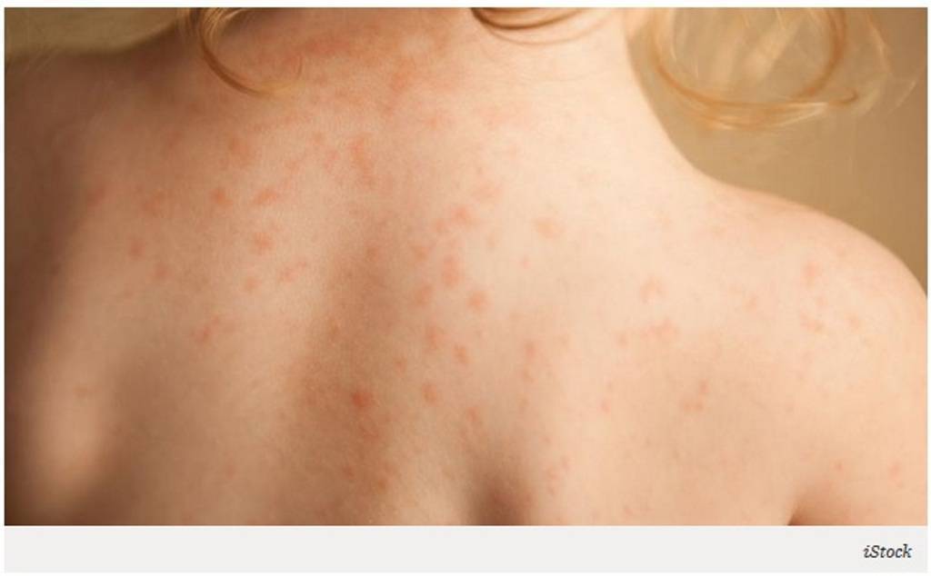 Allergia al sole, come proteggersi dalla lucite estiva benigna