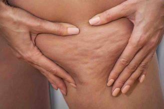 Cellulite che cos'è