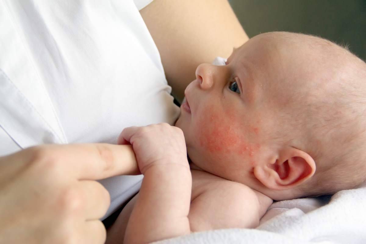 Dermatite atopica nei bambini i consigli dell'ospedale pediatrico Bambino Gesù