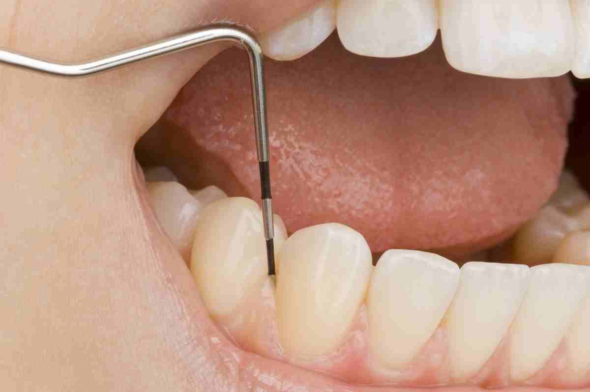 In alcuni pazienti affetti da Covid si è avuta una caduta dei denti