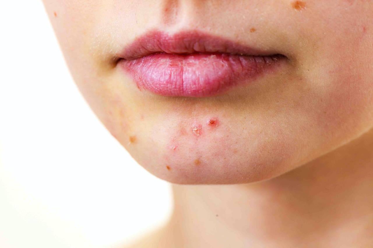 acne estate