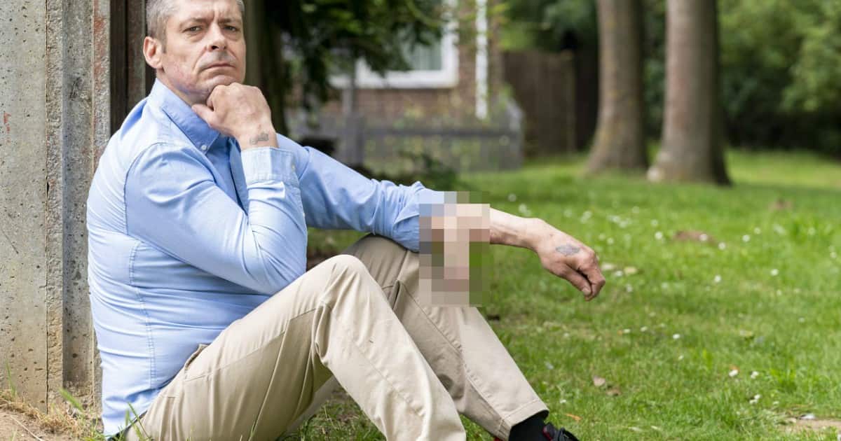 Impianto del pene sul braccio