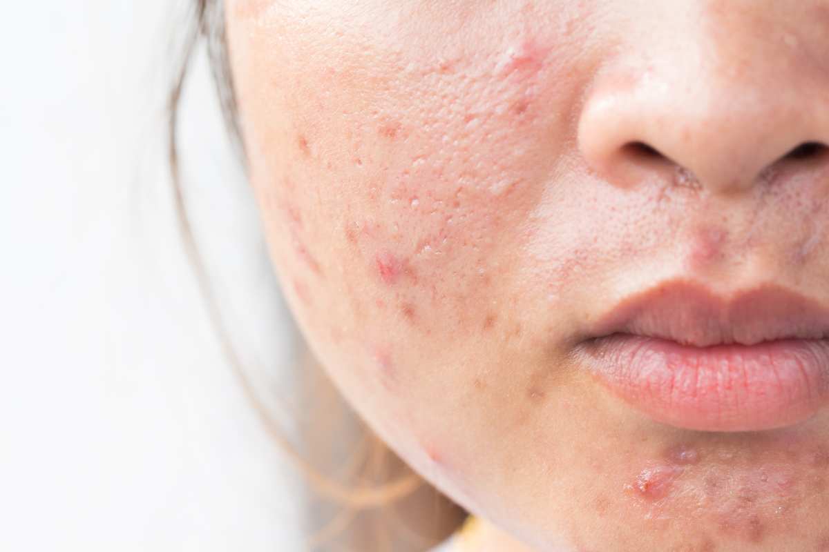 acne come affrontarla con il dermatologo 