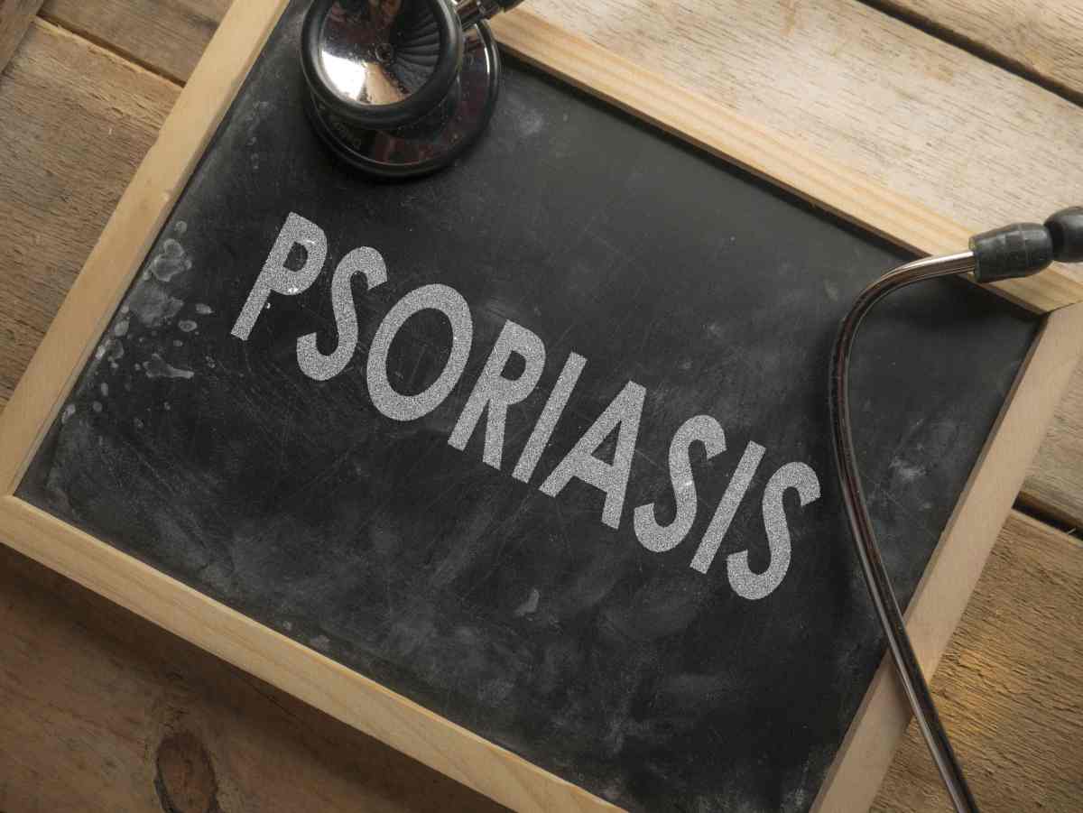 psoriasi viso pelle secca 