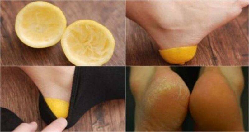 limone cura dei piedi