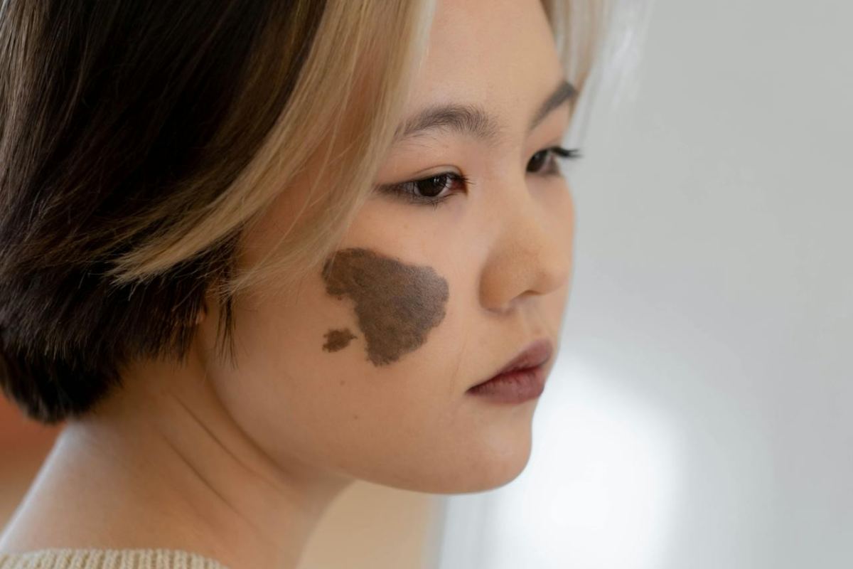 Voglia sul viso di una donna