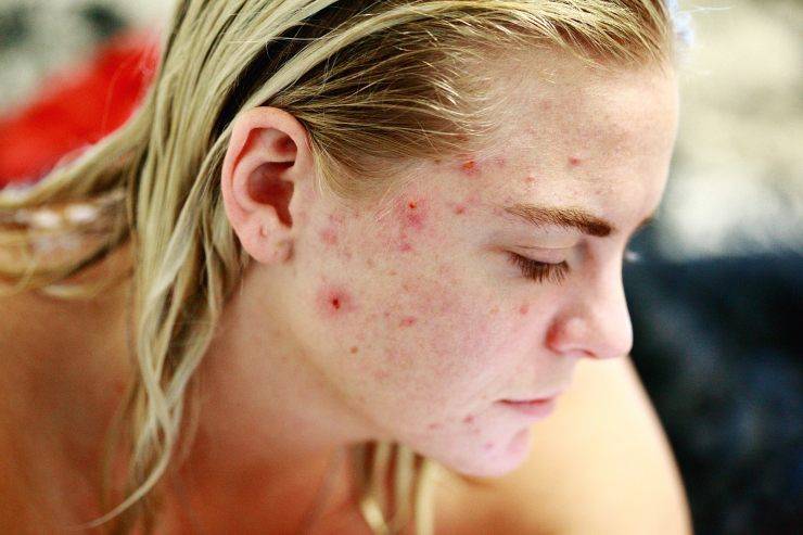 acne e skincare donna con acne 