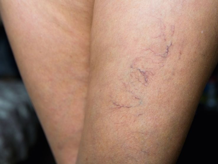 capillari gambe donna