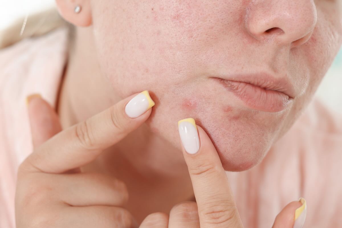 donna tenta di schiacciare brufolo