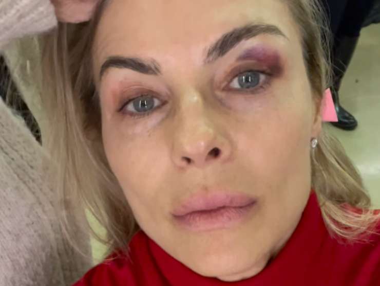 martina colombari con l'occhio livido nelle sue ig stories