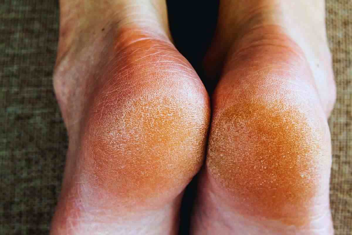 piedi con talloni secchi